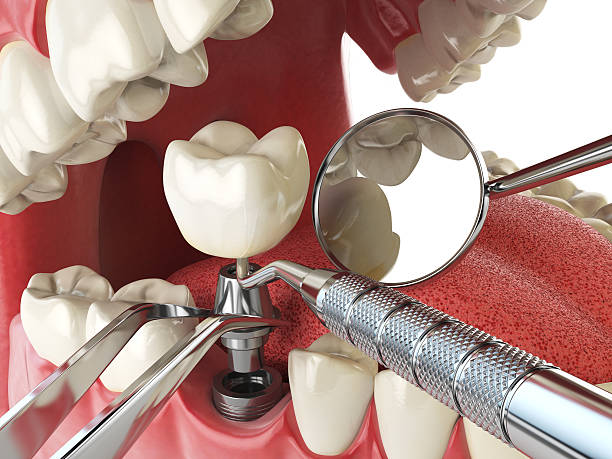 Best Emergency Treatment for Dental Infections or Abscesses in Fredonia, NY