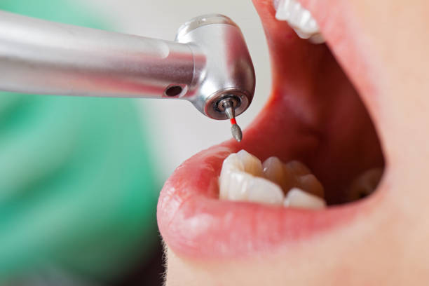 Best Emergency Dental Care for Broken or Chipped Teeth in Fredonia, NY